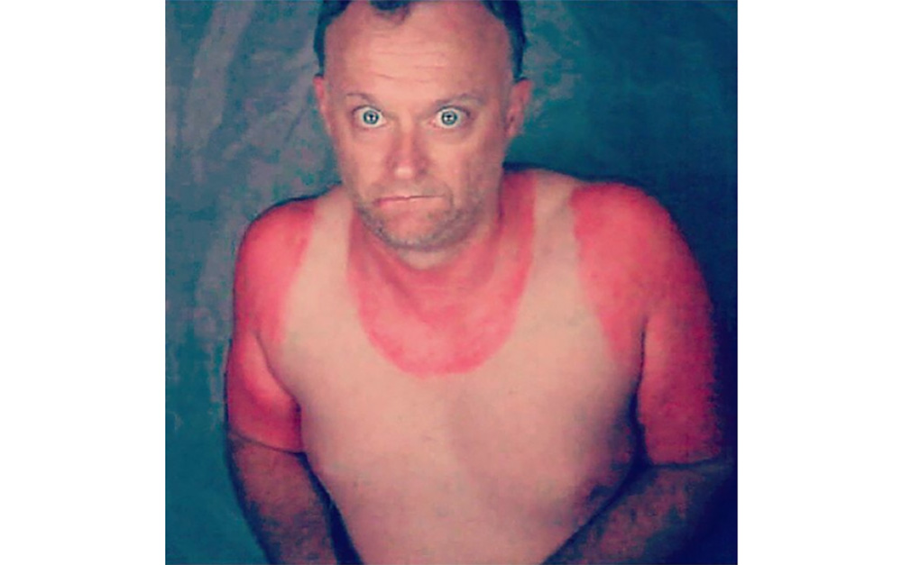 adventure-unfiltered-top-10-bad-sunburn-photos-g-adventures